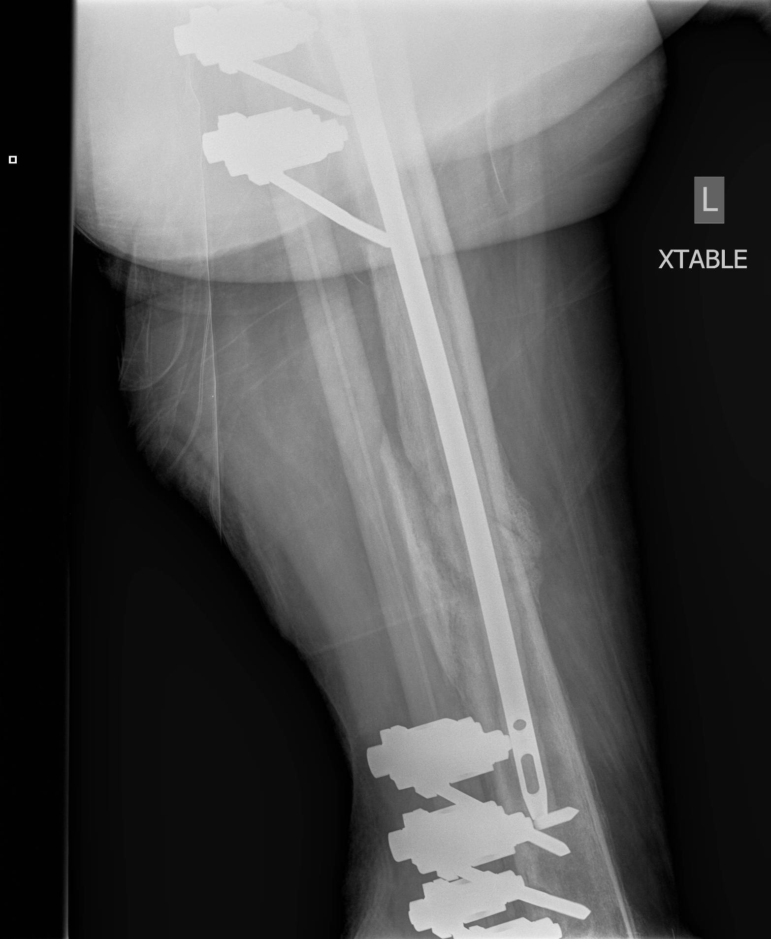 Infected Femoral Nail3